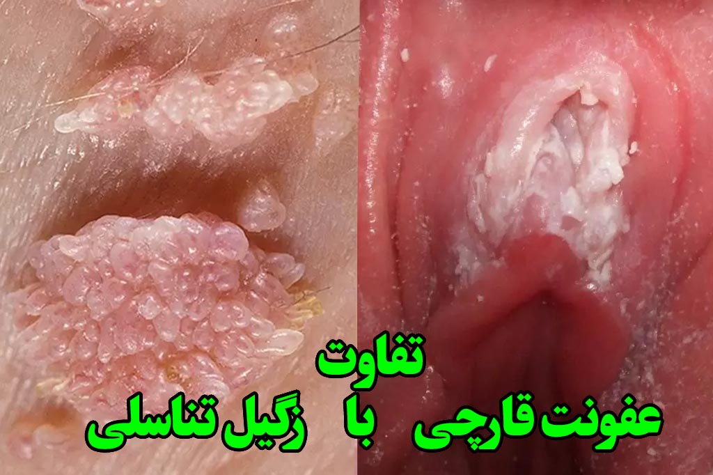 تفاوت عفونت قارچی با زگیل
