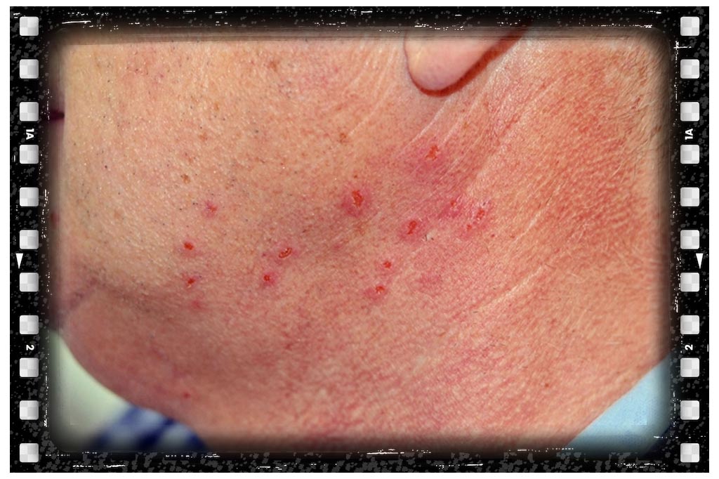 جای نیش حشرات