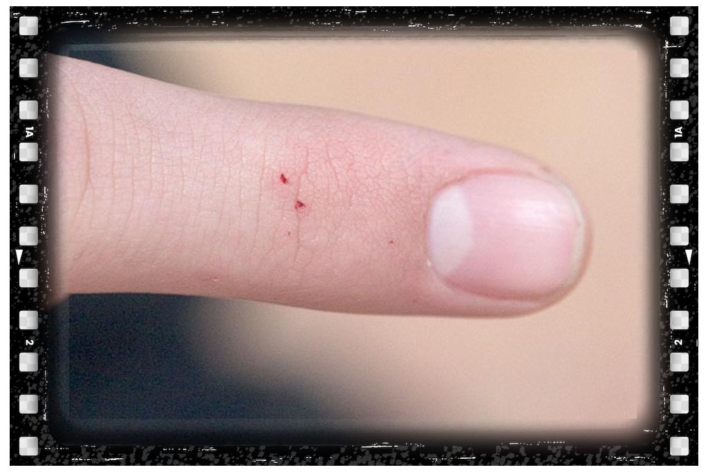 جای نیش حشرات رتیل