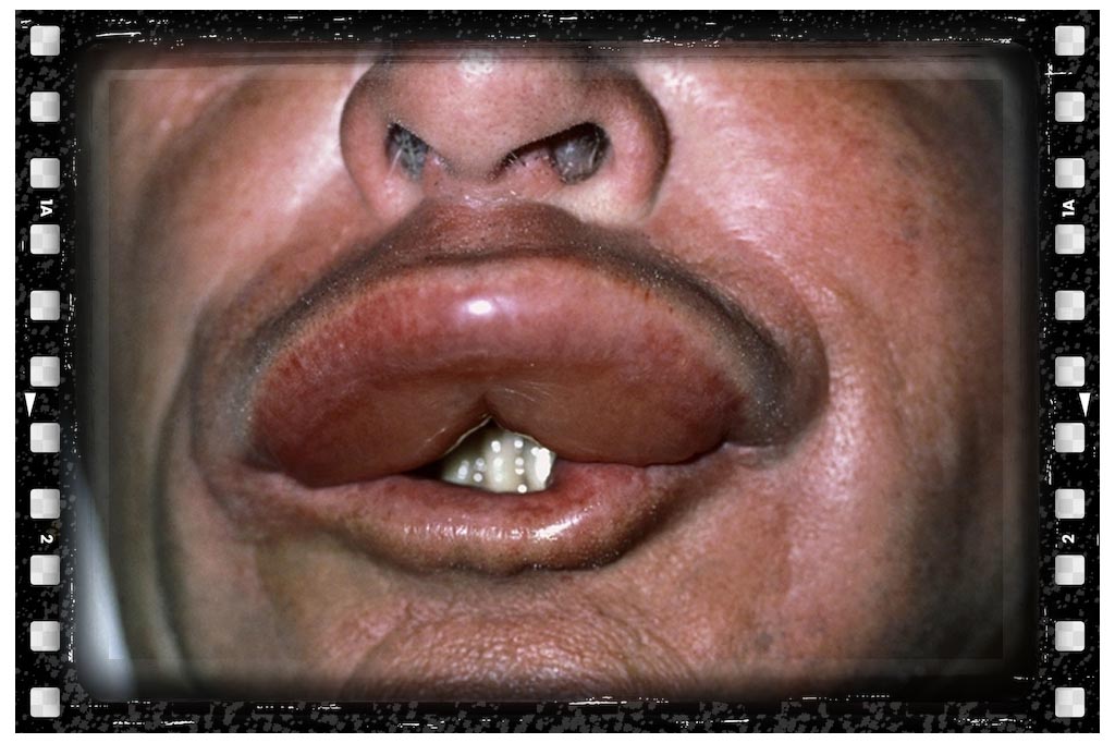 جای نیش حشرات زنبور زر