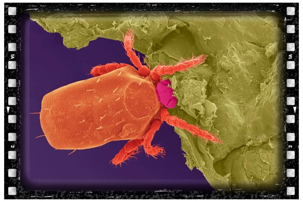 جای نیش حشرات