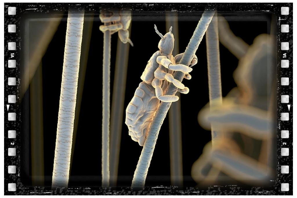 جای نیش حشرات شپش