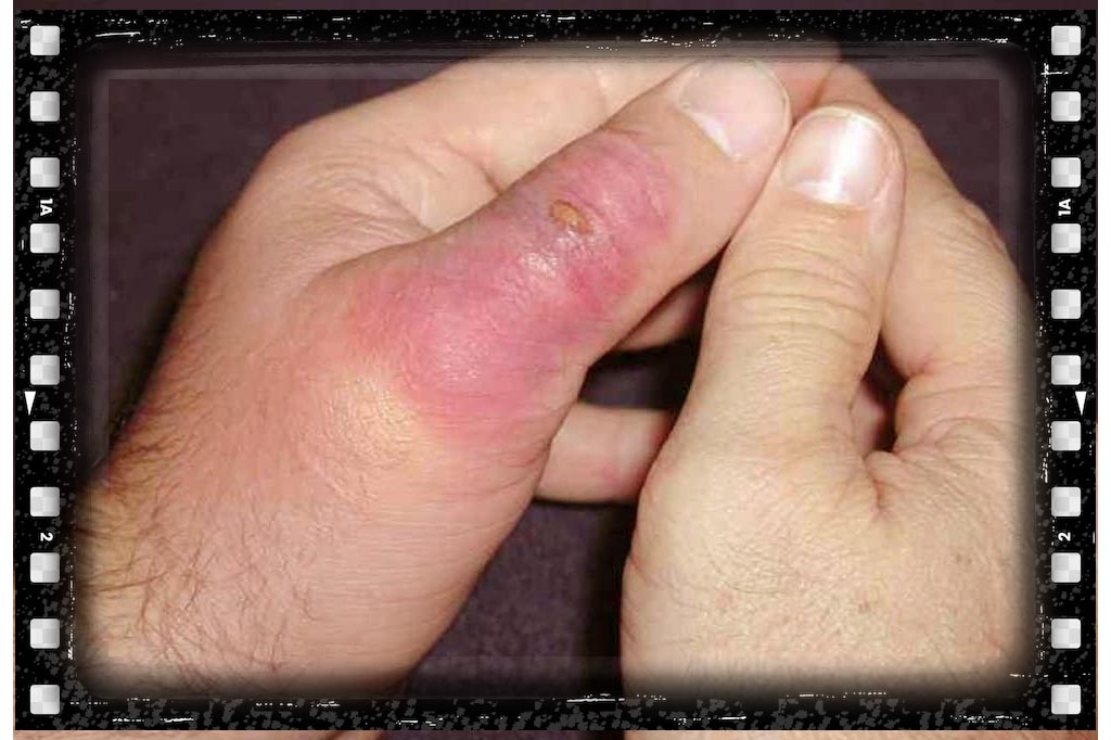 جای نیش حشرات عقرب