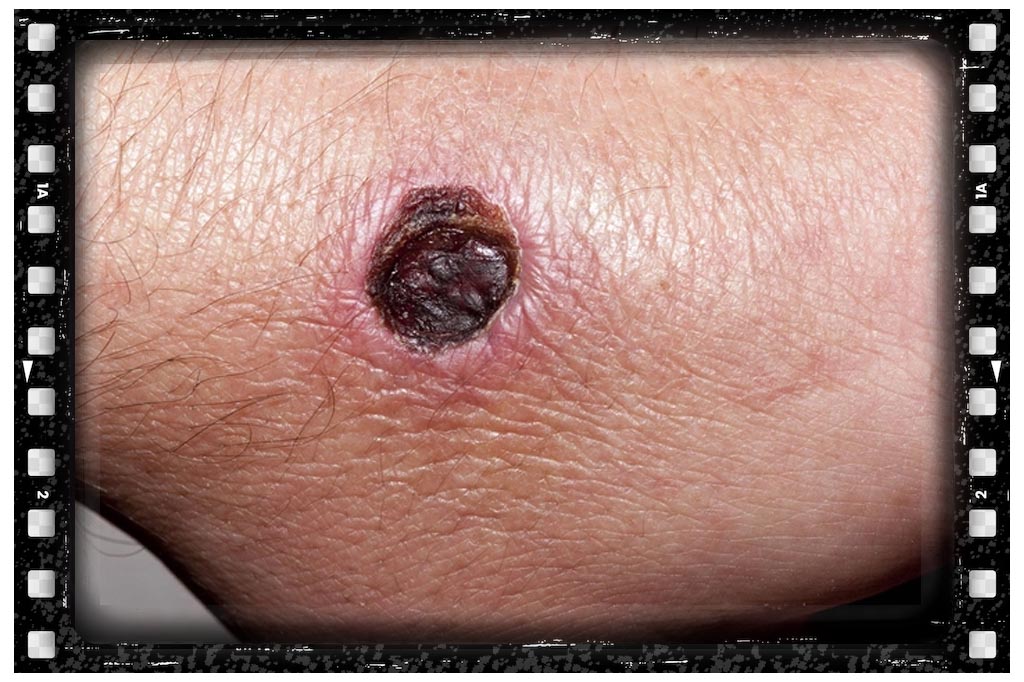 جای نیش حشرات عنکبوت