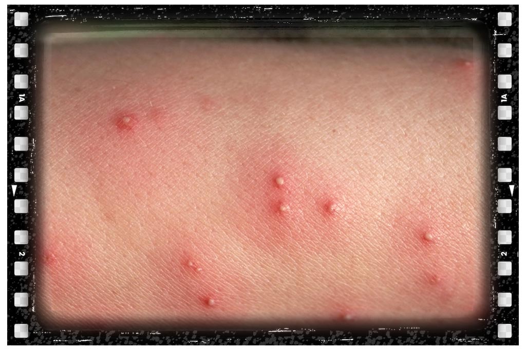 جای نیش حشرات مورچه