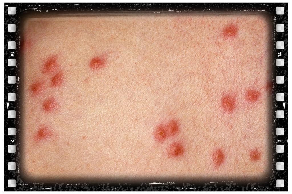 جای نیش حشرات