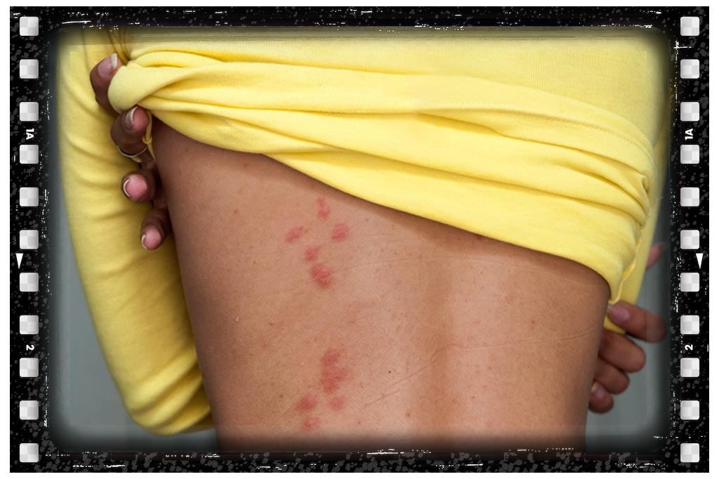 جای نیش حشرات ساس