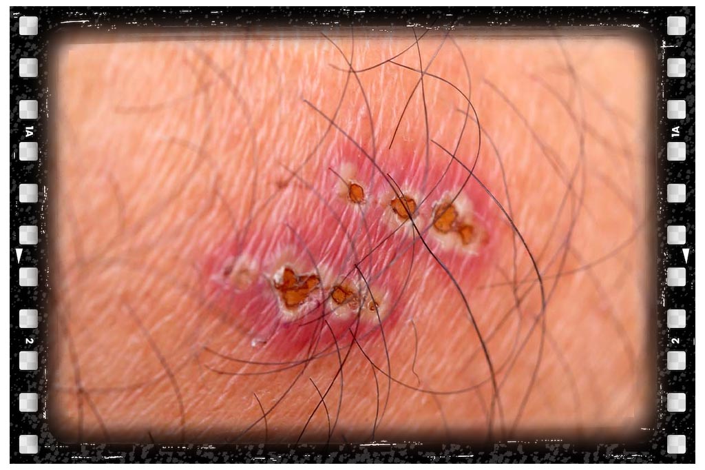 جای نیش رتیل