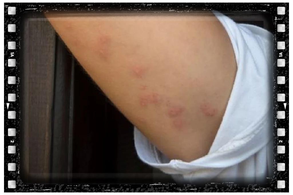 جای نیش سوسک