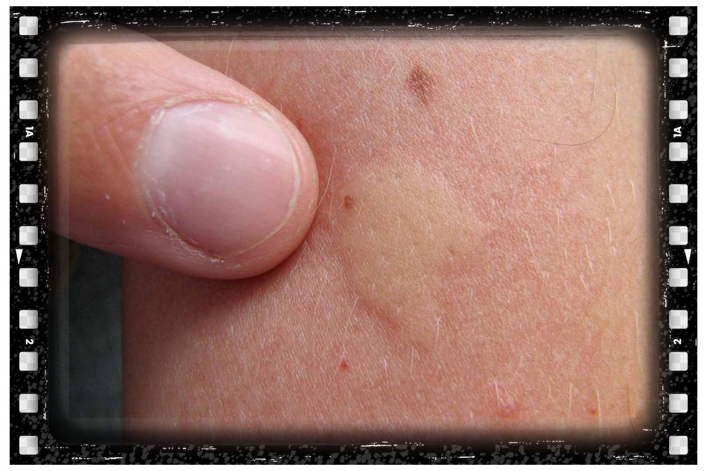 جای نیش پشه