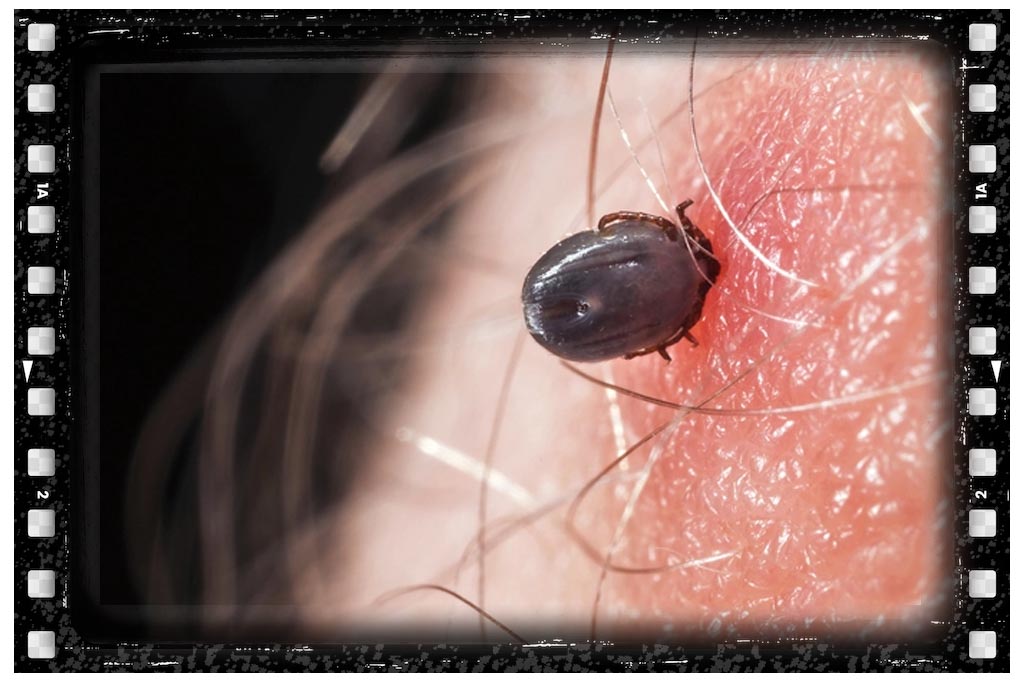 جای نیش کنه