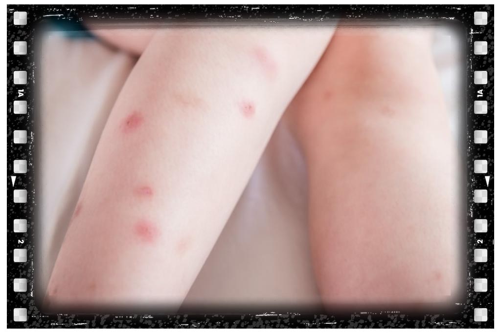 عکس جای نیش سوسک