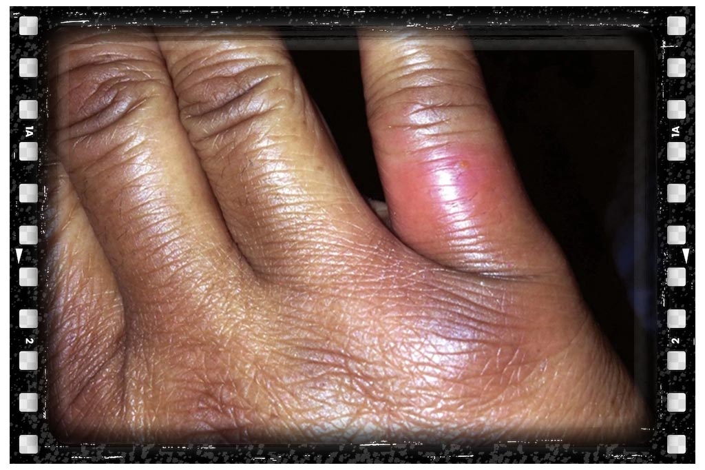 عکس جای نیش حشرات عنکبوت