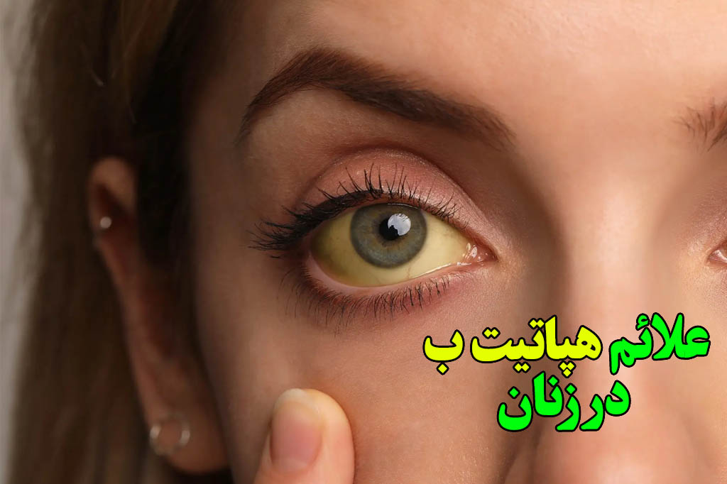 هپاتیت ب در چشم زنان