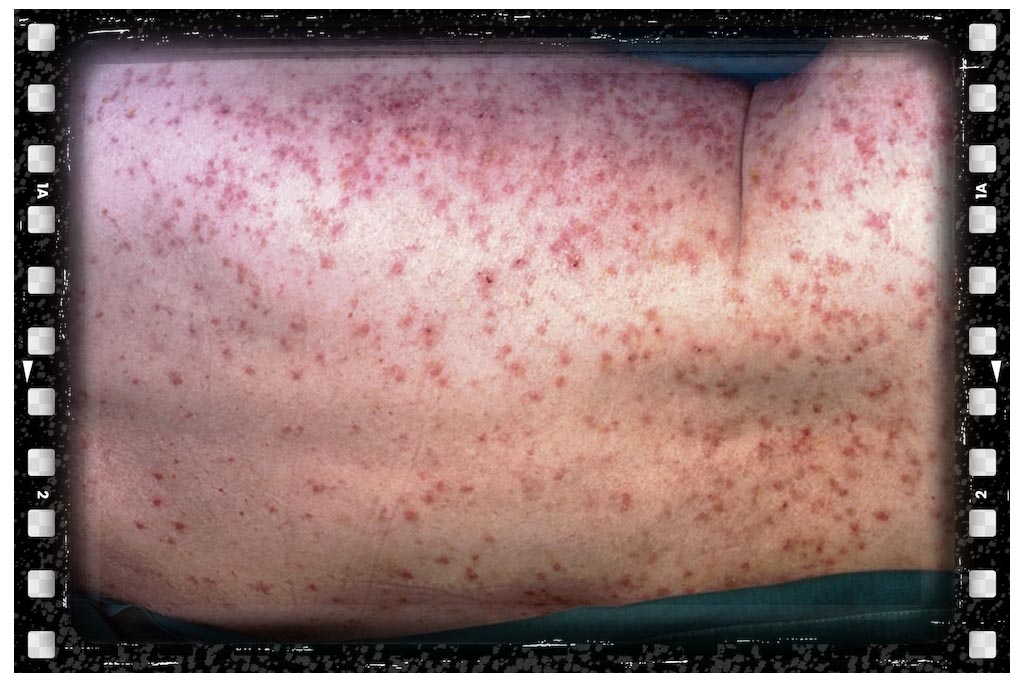 یجای نیش حشرات گال