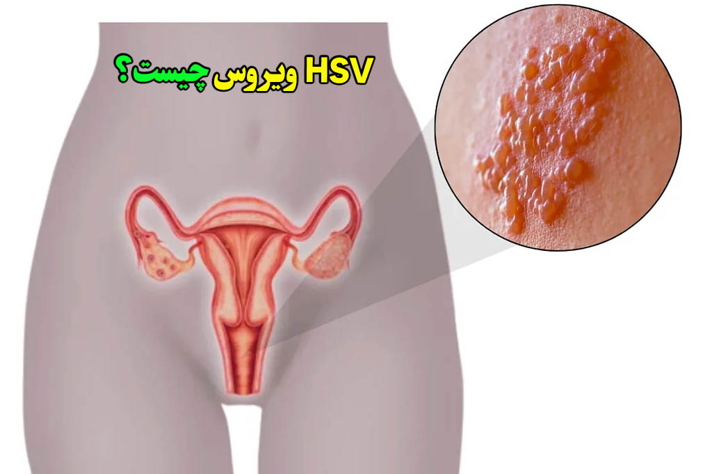 آزمایش ویروس زنان چیست hsv