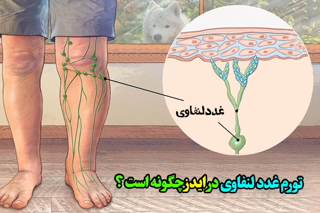 HIV چگونه باعث تورم غدد لنفاوی میشود؟