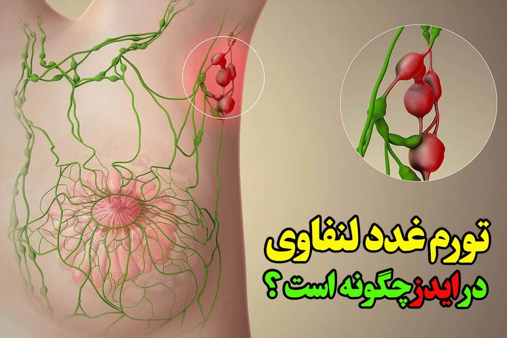 تورم غدد لنفاوی مبتلایان ایدز