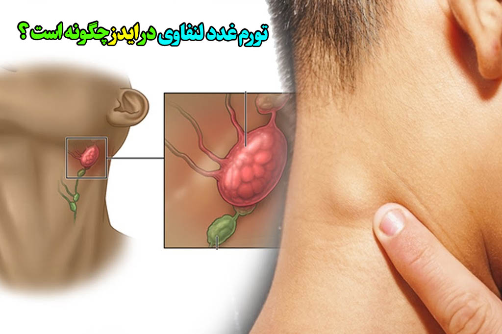 درمان بزرگ شدن غدد لنفاوی و ایدز
