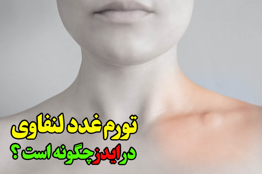 تورم غدد لنفاوی در اثر ایدز خطرناک است