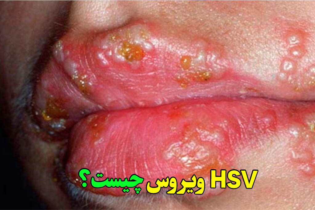 ویروس چیست hsv