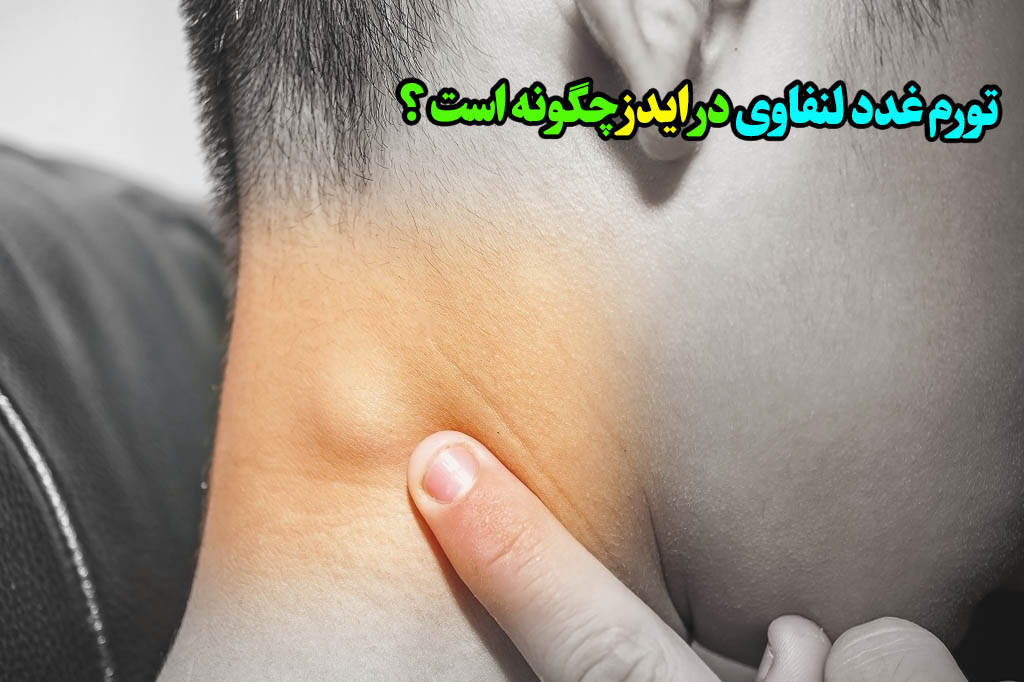 شکل ظاهری تورم غدد لنفاوی در ایدز