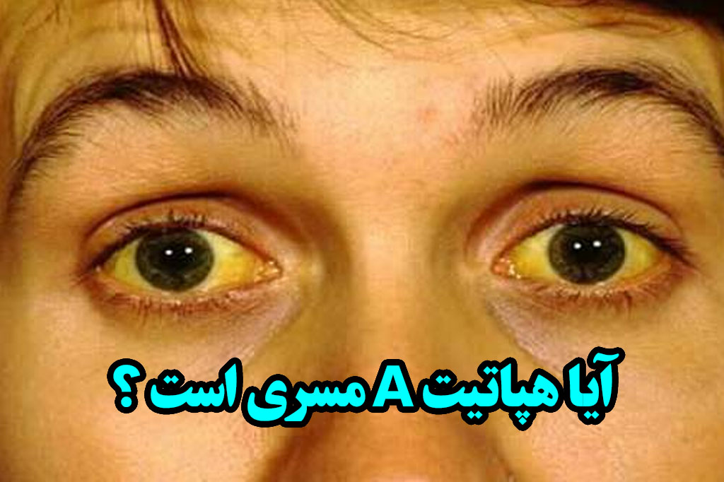 هپاتیت a مسری است