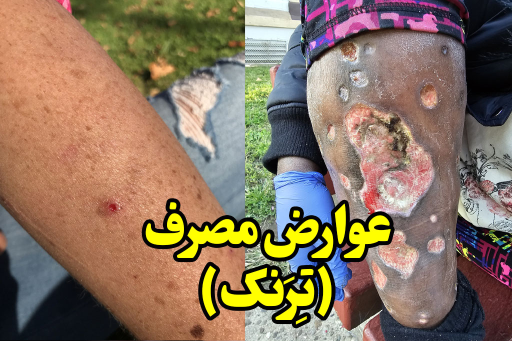 عوارض مصرف ترنک