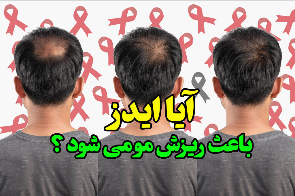hiv باعث ریزش مو