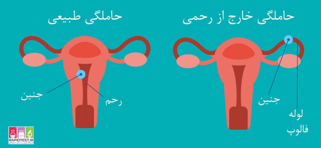 درمان حاملگی خارج از رحم